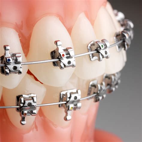 what is omni metal dental brackets|orthotic brackets.